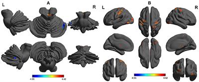 Altered Regional Cortical Brain Activity in Healthy Subjects After Sleep Deprivation: A Functional Magnetic Resonance Imaging Study
